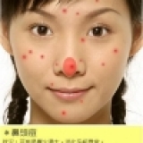 痘痘是為了什麼冒出?