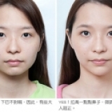 V+立提長效型玻尿酸─隆出自然鼻，才是美人真諦